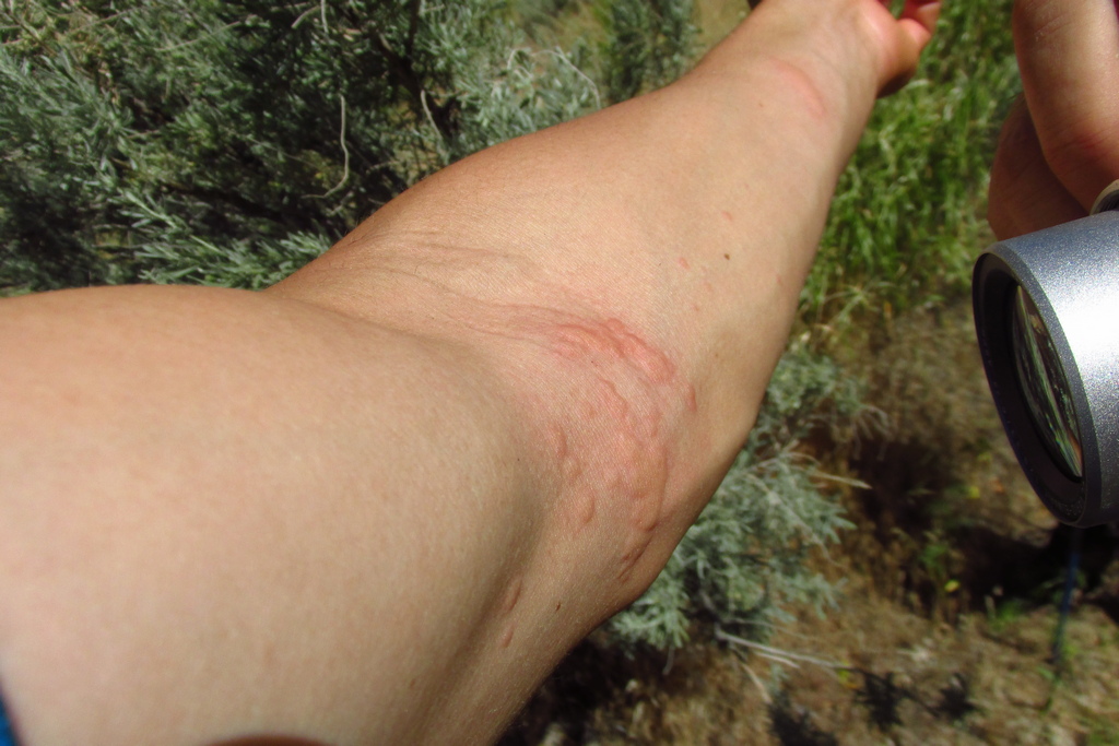 Gary's Encounter with Stinging Nettle
